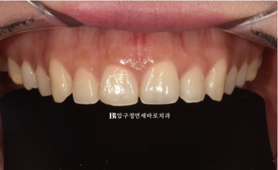 Non-Prep Veneer Review | A Case Naturally Improving Gaps Between the Front Teeth and the Smile Line image 3