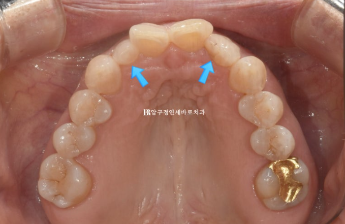 Can It Be Done in Your 50s? Real Results from Limited Front Teeth Orthodontics + No-Prep Laminate Veneers Revealed image 4