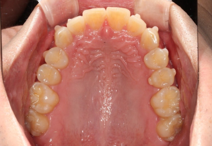 인비절라인 라이트 돌출 과개교합 중심선 교정 치간삭제 치료기간 관련 이미지 7