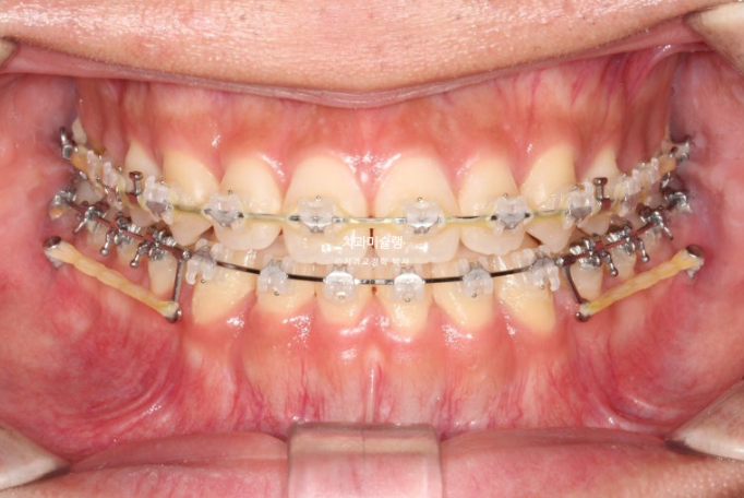 비수술 비발치 주걱턱 절충치료 클리피씨 개방교합 반대교합 치료 관련 이미지 8