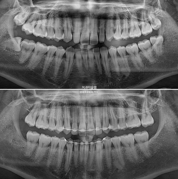 비대칭 비발치 거미스마일 잇몸미소 중심선 가위교합치료 무삭제 라미네이트 관련 이미지 30