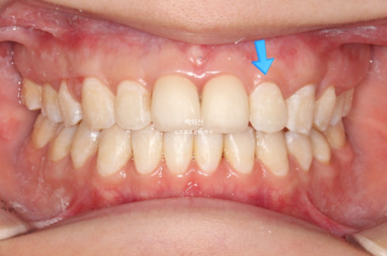클리피씨 교정에서 인비절라인 변경 마무리 인비절라인 라이트 치료기간 4개월 관련 이미지 5