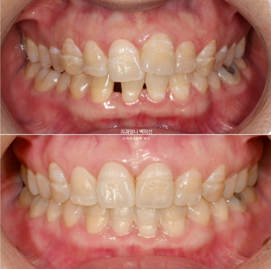 30대 교정 돌출입 교정 덧니 발치교정 치료기간 1년 8개월 관련 이미지 1