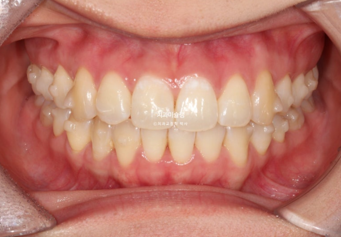 인비절라인 비발치 토끼이빨 교정 덧니 교정 치료기간 1년 8개월 관련 이미지 6