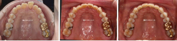 50대 60대 중년 치아 벌어짐 단기 교정 해결하기 관련 이미지 3