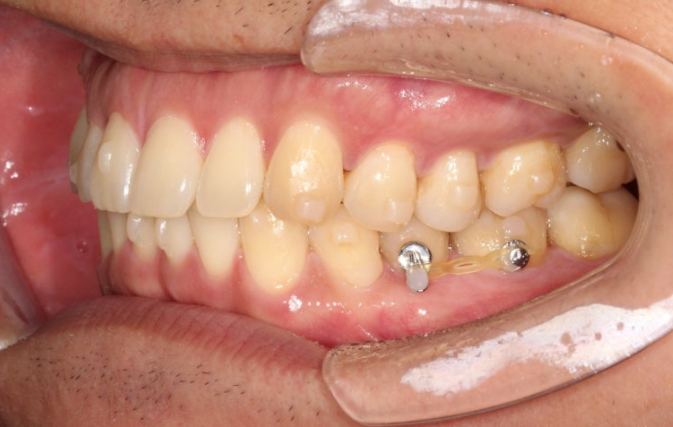 가위교합 벌어짐 중심선 과개교합 인비절라인 라이트 교정 관련 이미지 9