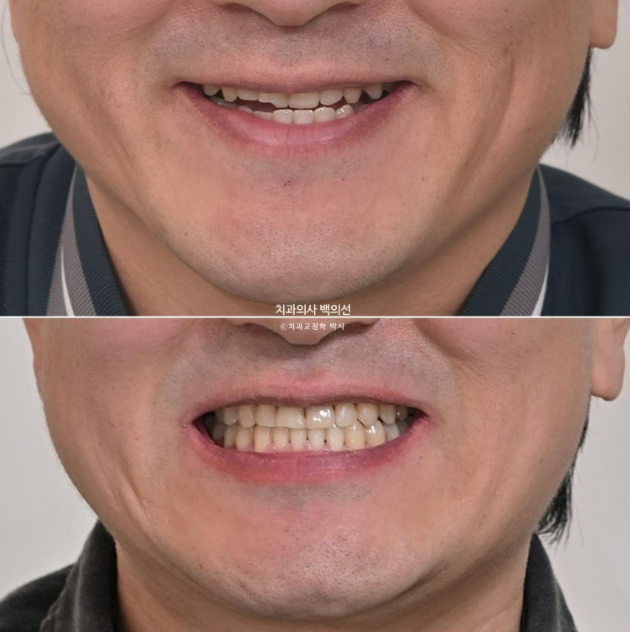 40대 인비절라인 비수술 비발치 주걱턱 비대칭 교정 관련 이미지 16