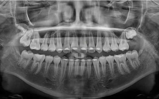 어린이 투명교정 인비절라인 틴 덧니 교정 후기 관련 이미지 15
