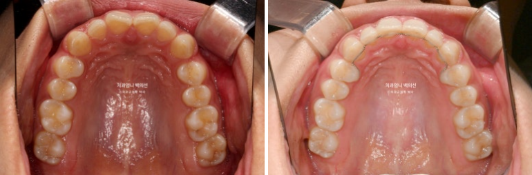 과개교합 옥니 거미스마일 교정 인비절라인 라이트 잇몸성형 후기 관련 이미지 14