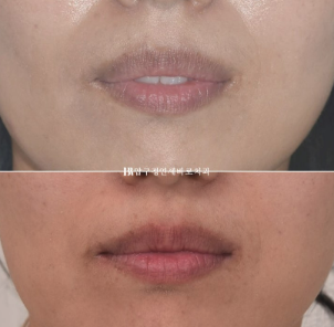 Orthodontic Retreatment in Your 40s | Improvement of Chin Retrusion and Lip Incompetence with Intrusion Orthodontics, Non-Extraction Orthodontic Treatment in Your 40s image 9