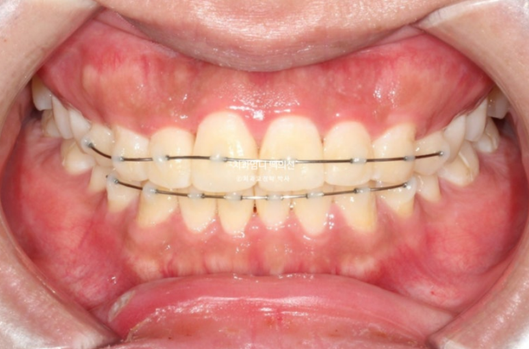 앞니 부분교정 덧니 교정 블랙트라이앵글 부정교합 마모 시뮬레이션 치료기간 5개월 관련 이미지 9