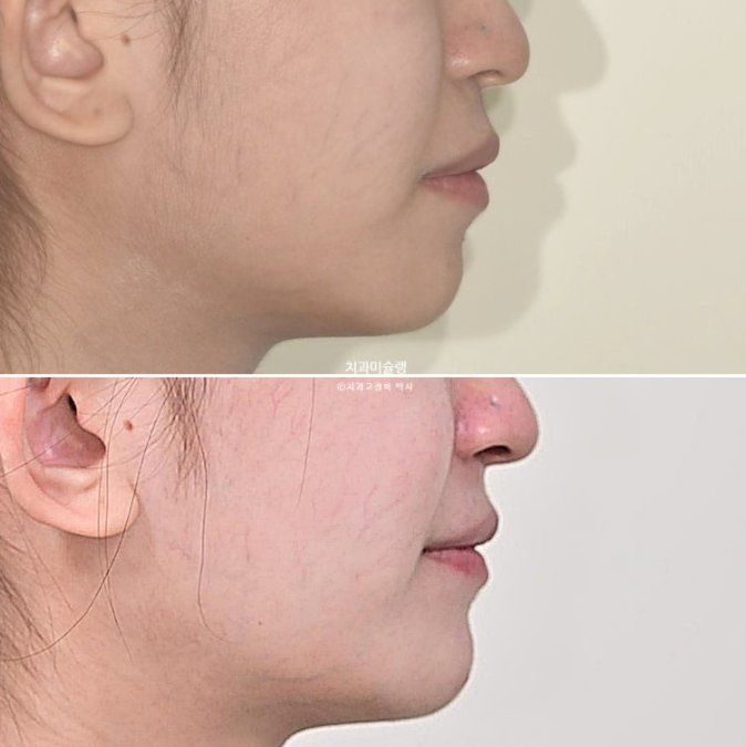 잇몸미소 거미스마일 치료 옥니 교정 잇몸성형 후기 관련 이미지 21