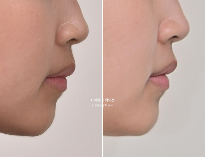 인비절라인 개방교합 교정 어금니 함입 교정 비베라? 관련 이미지 16