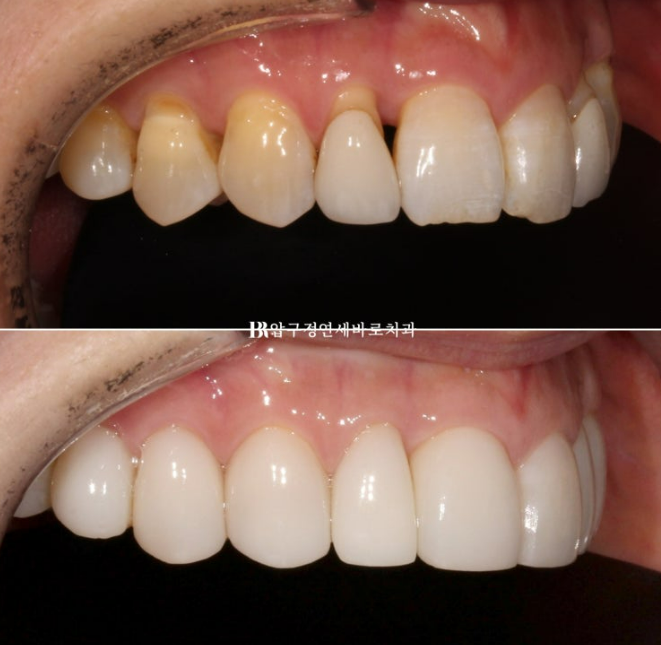 40대 오래된 크라운 교체 / 블랙트라이앵글 젤라미 치료 결과 관련 이미지 7