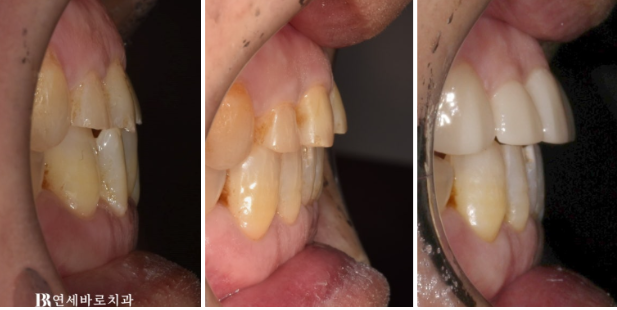 60대 무삭제 라미네이트 앞니 부분교정 치료 관련 이미지 9