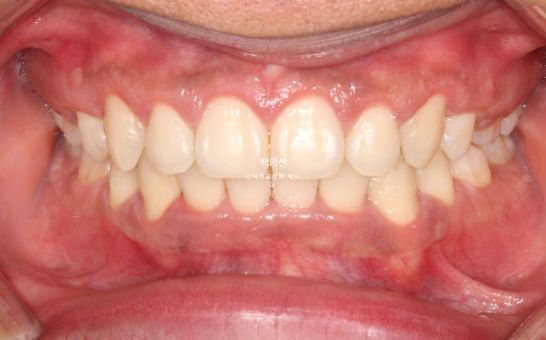 거미스마일 잇몸미소 발치 돌출입 과개교합 교정 후기 관련 이미지 10