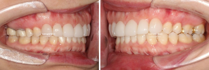 비발치 덧니 교정 인비절라인 과개교합 교정 무삭제 라미네이트 치료 후기 관련 이미지 17