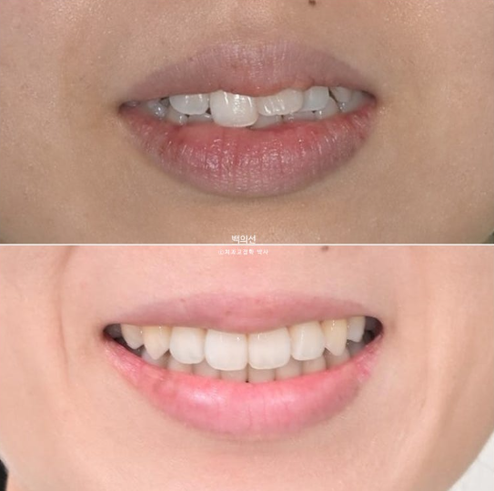 30대 돌출입 덧니 교정 인비절라인 발치교정 후기 관련 이미지 19