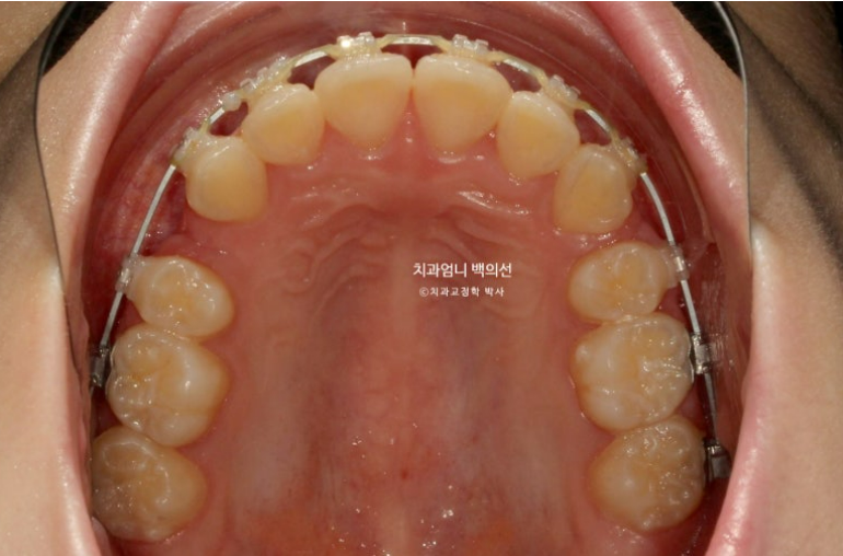 입이 안 다물어짐 입술부전증 호두턱 교정? 관련 이미지 8