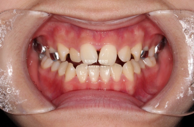 중학생 주걱턱 반대교합 개방교합 덧니 교정 인비절라인 후기 관련 이미지 4