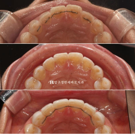 Laminate Veneers in Your 50s: Is It Possible Without Shaving Down the Teeth? | No-Prep Laminate Veneers + Real Case of Front Tooth Partial Orthodontics image 11