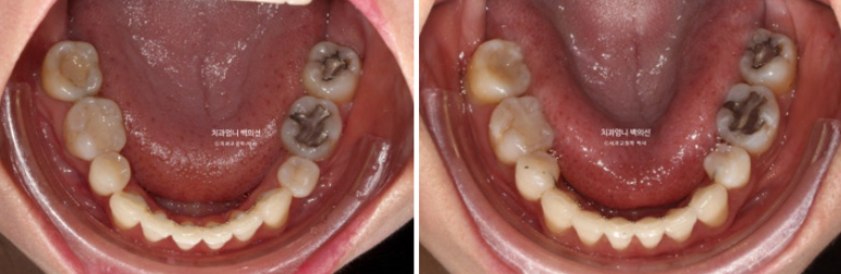 옥니 교정 역교정 재교정 무턱교정 치료기간 1년 10개월 관련 이미지 17