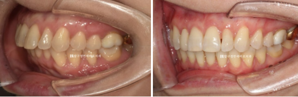 Can Invisalign Lite Work for Patients in Their 40s? A Real Case Improving Scissor Bite and Deep Bite in 10 Months image 15