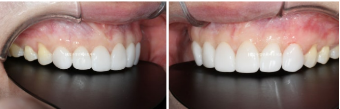 벌어진 치아 교정 인비절라인 라이트 무삭제 라미네이트 치료 관련 이미지 18