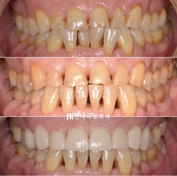 60대 무삭제 라미네이트 앞니 부분교정 치료 관련 이미지 12