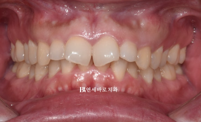 인비절라인 비추천 하는 경우? 관련 이미지 5