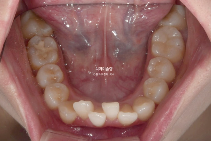 심한 돌출입 입술부전증 호두주름 발치교정 치료 관련 이미지 5