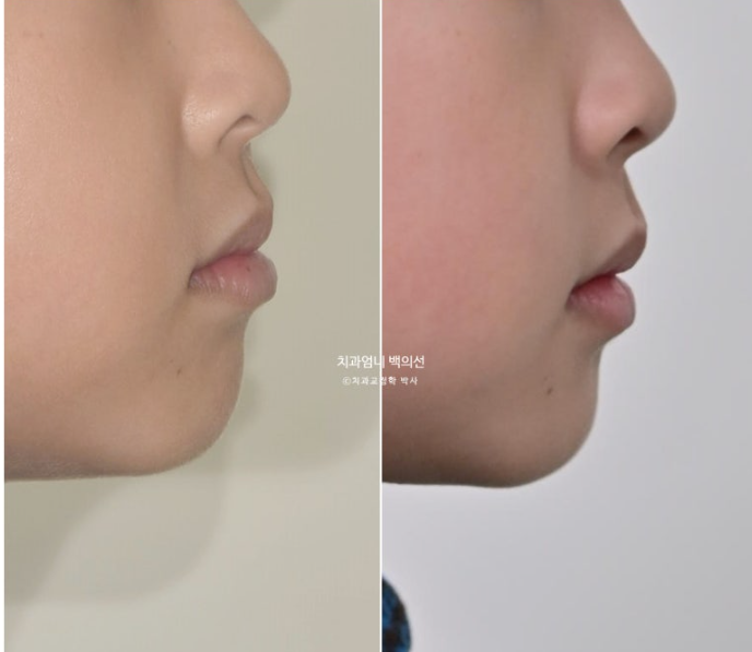 어린이 교정 인비절라인 퍼스트 비대칭 반대교합 어린이 성장 교정 관련 이미지 24