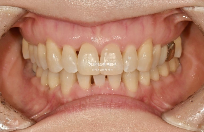 50대 치아교정 중년 발치교정 블랙트라이앵글 치료 후기 관련 이미지 12