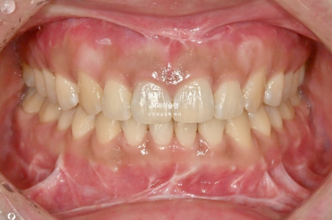 선수술 양악수술 비대칭 주걱턱 잇몸미소 치료 인비절라인 라이트 관련 이미지 13