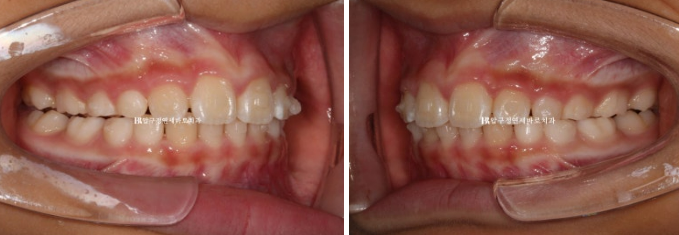 Invisalign First Correction for a Retruded Chin in a Child Orthodontic Treatment for Protrusion image 6