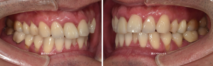 안보이는 앞니 교정 2D 교정 부분교정 후기 / 교정 시 잇몸이 더 나빠지지 않을까요? 관련 이미지 2