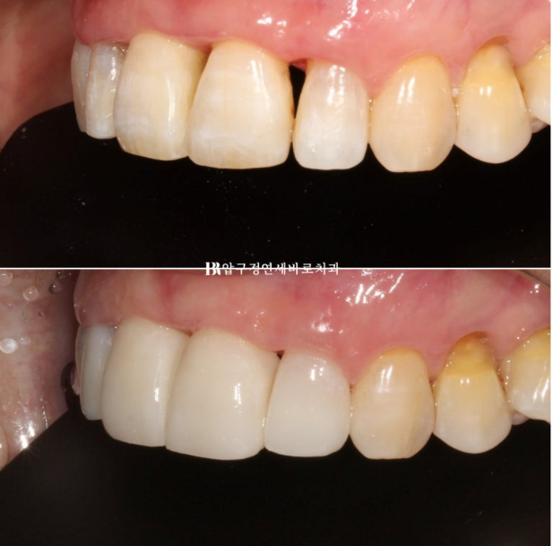 60대도 가능할까? 치주염&middot;벌어진 앞니를 살린 무삭제 라미네이트 치료 이야기 관련 이미지 7