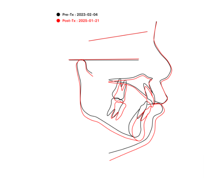 무턱교정 어린이 투명교정 인비절라인 퍼스트 교정 후기 관련 이미지 25