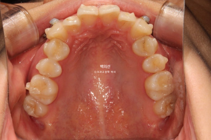 비발치 덧니교정 인비절라인 교정 사랑니 이용 교정 관련 이미지 11