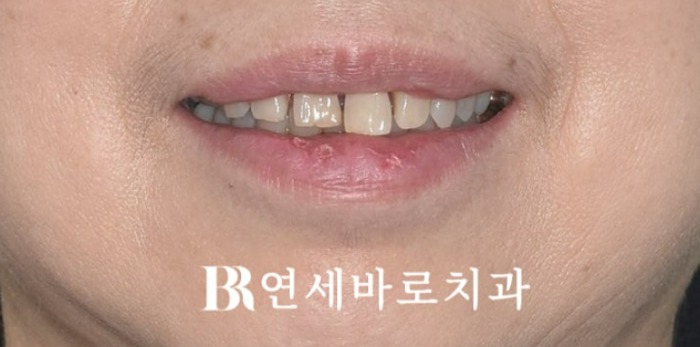 50대 치아벌어짐 단기 교정 가능할까요? 관련 이미지 1