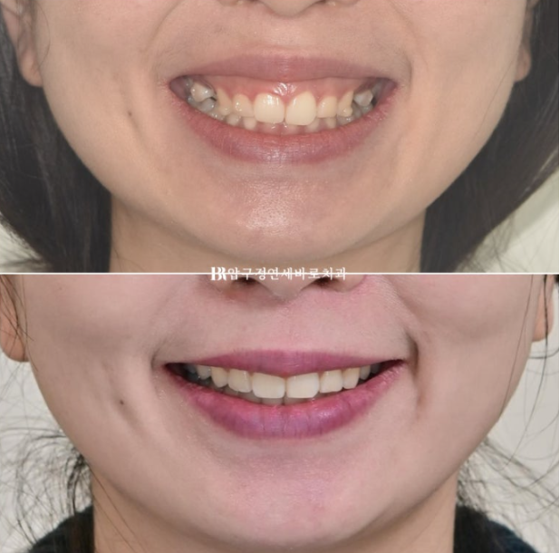 Can't Invisalign Move the Roots? An Actual Case of Extraction Treatment for Protruding Mouth at a Gangnam Orthodontic Clinic image 13