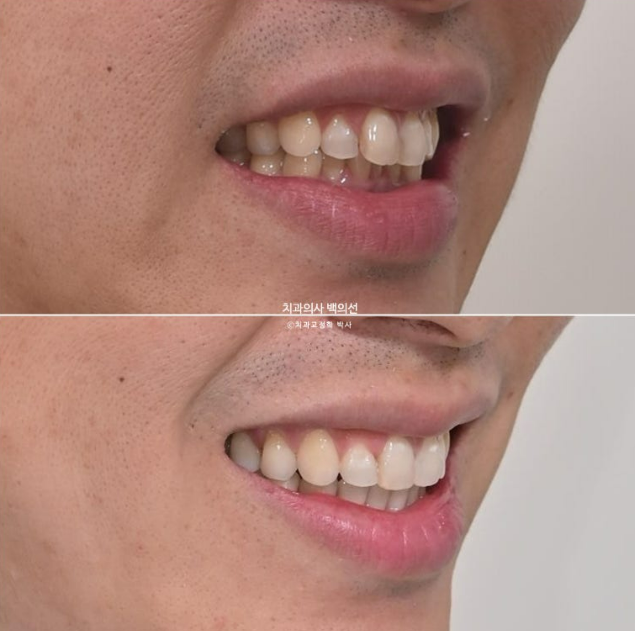 40대 인비절라인 라이트 과개교합 과잉치 덧니 교정 임플란트 보철 교정 후기 관련 이미지 24
