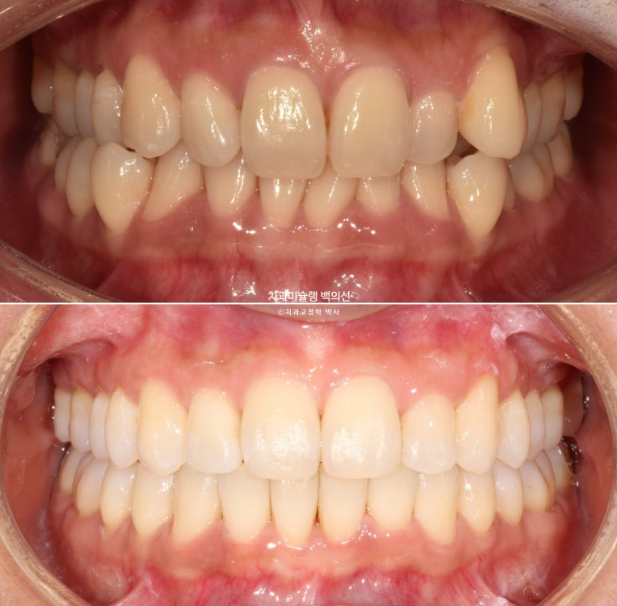 옥니 덧니 과개교합 반대교합 중심선 인비절라인 치료기간 1년 관련 이미지 13