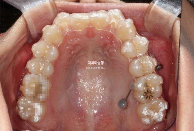 유학생 치아교정 해외거주 한국에서 치아교정? 관련 이미지 8