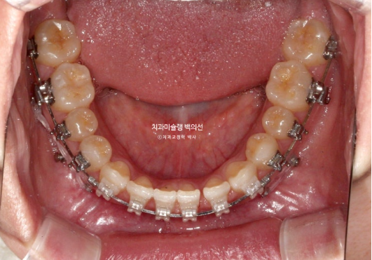 앞니 벌어짐 합죽이 방지 교정 기간 1년 4개월 관련 이미지 8