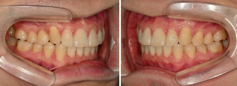 인비절라인 라이트 돌출 과개교합 중심선 교정 치간삭제 치료기간 관련 이미지 10