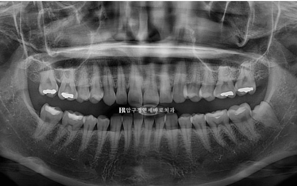 Can't Invisalign Move the Roots? An Actual Case of Extraction Treatment for Protruding Mouth at a Gangnam Orthodontic Clinic image 16