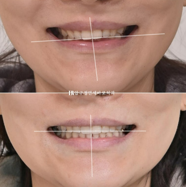 인비절라인 캔팅 교정 과개교합 교정 임플란트 재교정 관련 이미지 15