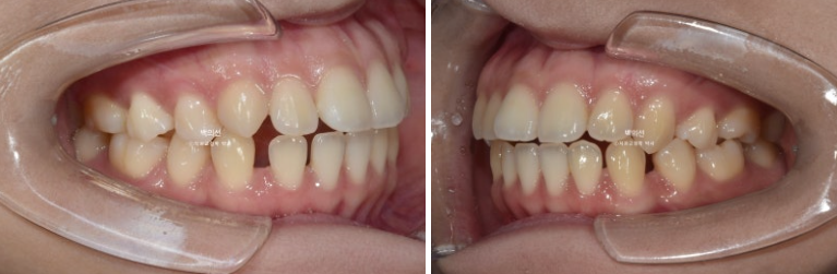 돌출입 교정 인비절라인 발치 교정 개방교합 치료 후기 관련 이미지 3