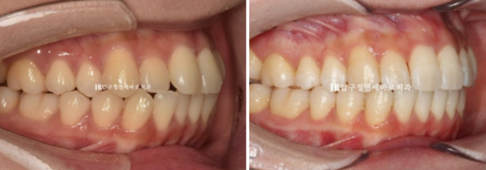 Invisalign Lite Treatment for Crossbite, Rabbit Teeth, and Protruding Front Teeth Correction image 8